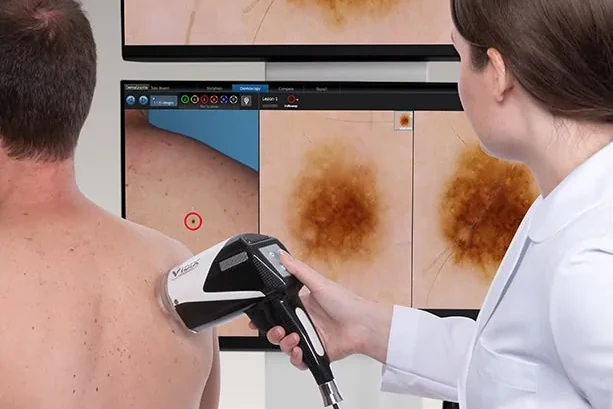 Videodermatoscopio VIDIX